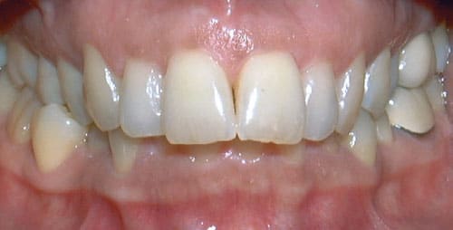 Overbite Delta Smiles in Antioch Brentwood CA