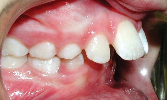 Protrustion Delta Smiles in Antioch Brentwood CA