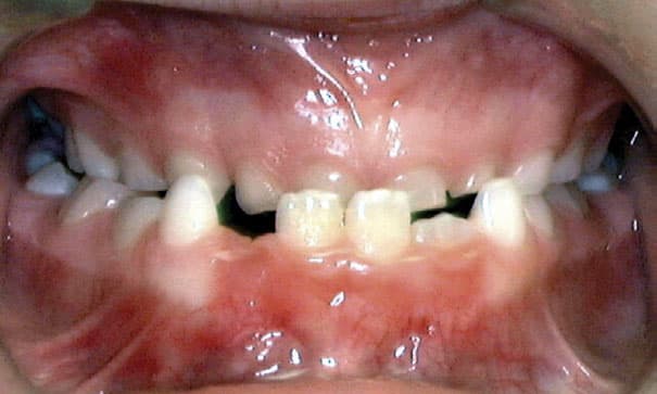 Underbite Delta Smiles in Antioch Brentwood CA